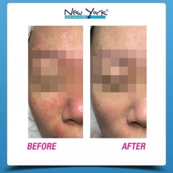 New-York-Skin-Solutions-HydroCollagen-Skin-Treatment-Promotion-1-350x350 7 Jan 2021 Onward: New York Skin Solutions HydroCollagen+ Skin Treatment Promotion