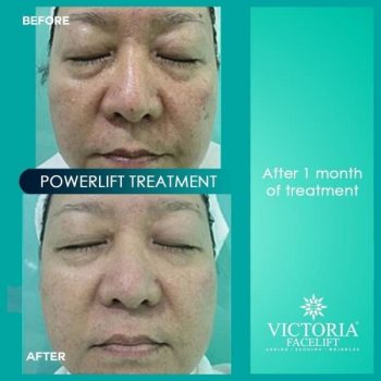 Victoria-Face-Lift-Powerlift-Facial-Promotion-350x350 19 Oct 2021 Onward: Victoria Face Lift  Powerlift Facial Promotion