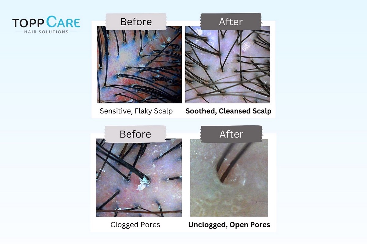 Before-After-Scalp-Scans Now till 30 Sept 2023: Bid Farewell to Your Scalp Worries with $269 off Topp Care’s Botanical Healthy Scalp Treatment + Free Gifts